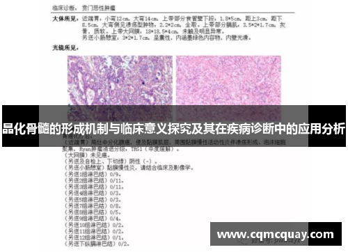 晶化骨髓的形成机制与临床意义探究及其在疾病诊断中的应用分析